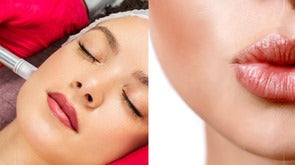 🔥💉 Dermapen + BB Lips - Yess Lacroix - TR3ndyFB