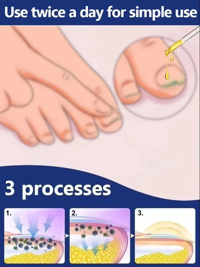 Laser Treatment for Nail Fungus - Restore Healthy Nails Fast