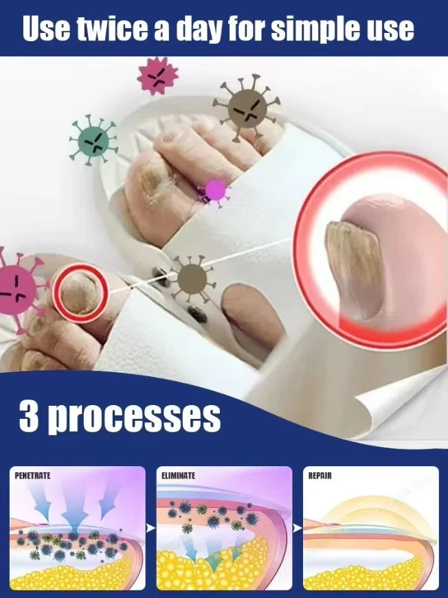 Laser Treatment for Nail Fungus - Restore Healthy Nails Fast