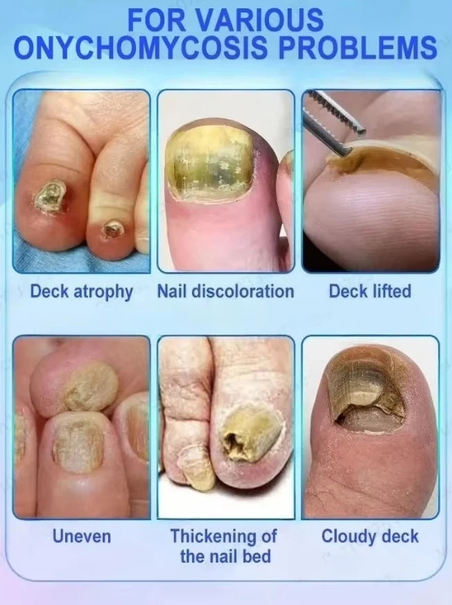 Laser Treatment for Nail Fungus - Restore Healthy Nails Fast
